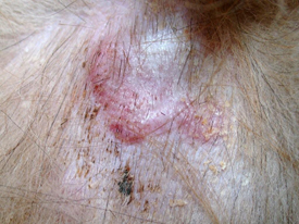Idiopathic Sterile Granuloma and Pyogranuloma