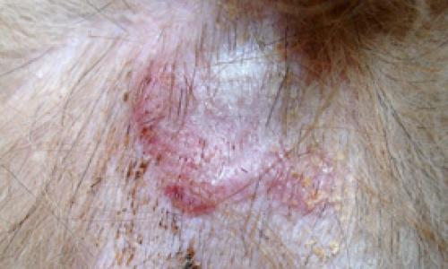 Idiopathic Sterile Granuloma and Pyogranuloma